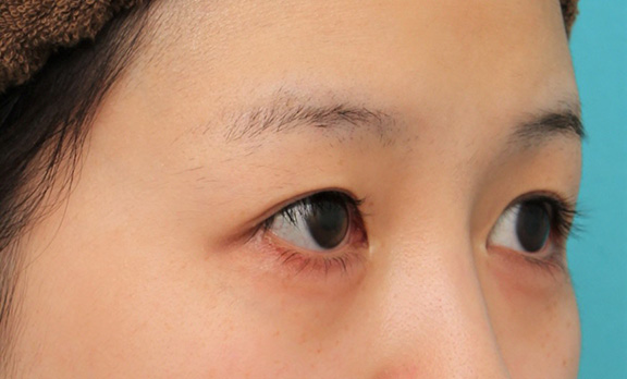 症例写真,目尻切開で目を外側に広げた20代女性の症例写真,Before,ba_mejiri022_b02.jpg