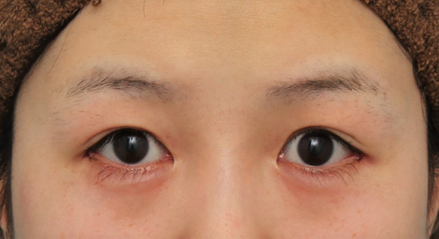 症例写真,目尻切開で目を外側に広げた20代女性の症例写真,手術直後,mainpic_mejiri022b.jpg