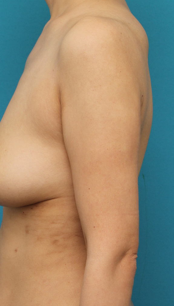 脂肪吸引,40代女性の太い二の腕を脂肪吸引で細くした症例写真,After（6ヶ月後）,ba_shibokyuin041_b01.jpg