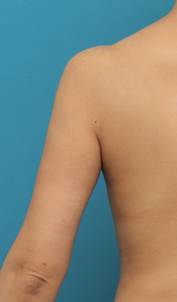 脂肪吸引,40代女性の太い二の腕を脂肪吸引で細くした症例写真,After（6ヶ月後）,ba_shibokyuin041_b02.jpg