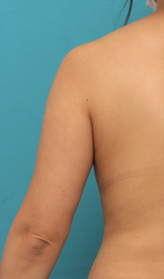 脂肪吸引,40代女性の太い二の腕を脂肪吸引で細くした症例写真,Before,ba_shibokyuin041_b02.jpg