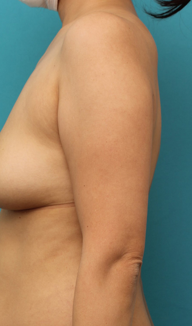 脂肪吸引,40代女性の太い二の腕を脂肪吸引で細くした症例写真,手術前,mainpic_shibokyuin041a.jpg