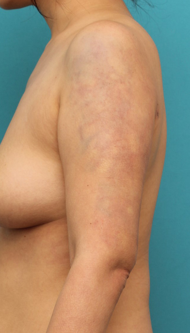 脂肪吸引,40代女性の太い二の腕を脂肪吸引で細くした症例写真,手術直後,mainpic_shibokyuin041b.jpg