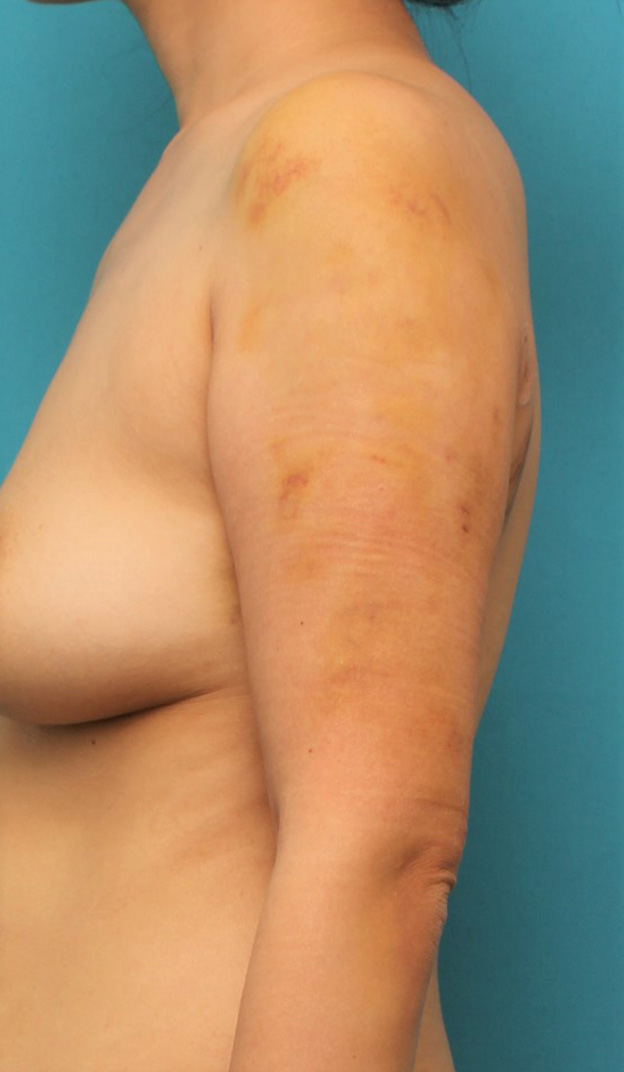 脂肪吸引,40代女性の太い二の腕を脂肪吸引で細くした症例写真,1週間後,mainpic_shibokyuin041c.jpg