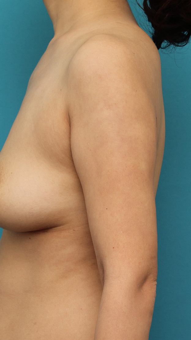脂肪吸引,40代女性の太い二の腕を脂肪吸引で細くした症例写真,6週間後,mainpic_shibokyuin041e.jpg