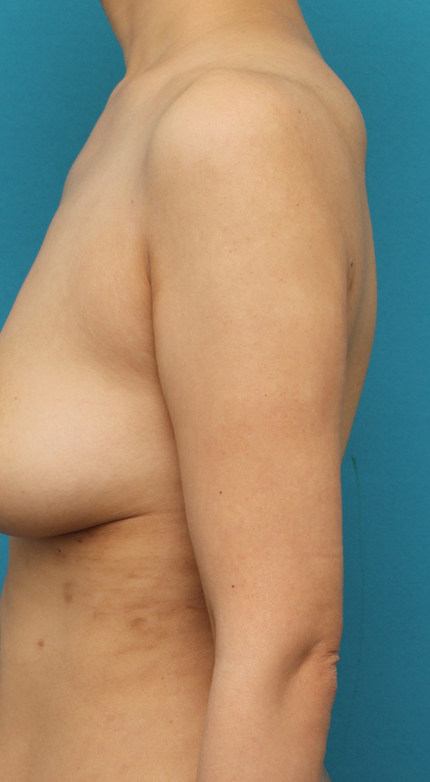 脂肪吸引,40代女性の太い二の腕を脂肪吸引で細くした症例写真,6ヶ月後,mainpic_shibokyuin041f.jpg