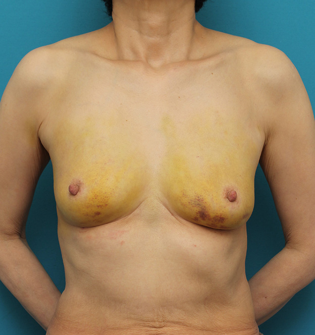他院で受けた手術の修正（豊胸・バスト・乳首）,豊胸シリコンプロテーゼ除去と同時にバスト脂肪注入した症例写真,1週間後,mainpic_shibo_hokyo_removal002c.jpg