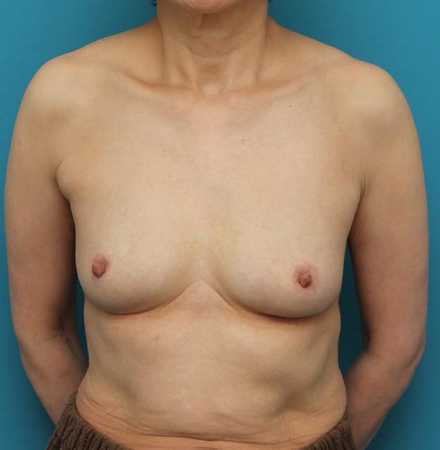 他院で受けた手術の修正（豊胸・バスト・乳首）,豊胸シリコンプロテーゼ除去と同時にバスト脂肪注入した症例写真,3週間後,mainpic_shibo_hokyo_removal002d.jpg