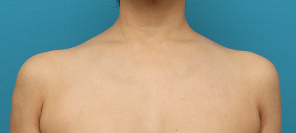 美人肩ボツリヌストキシン注射で肩の筋肉（僧帽筋）を萎縮させスッキリした症例写真,After（2ヶ月後）,ba_beautiful_shoulder_botox004_a01.jpg