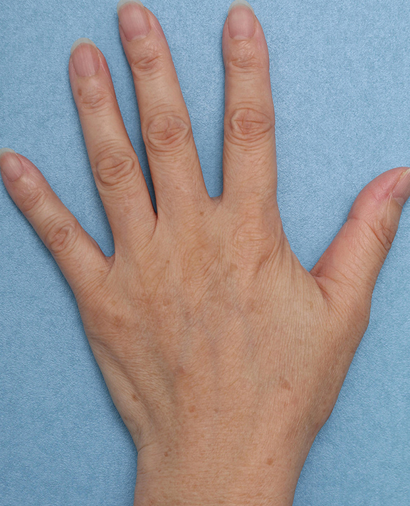 フォトフェイシャルM22,手の甲のシミ治療の症例写真,After（1回治療後）,ba_ipl011_b01.jpg