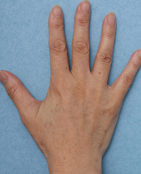 フォトフェイシャルM22,手の甲のシミ治療の症例写真,After（1回治療後）,ba_ipl011_b02.jpg