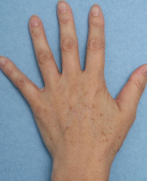 フォトフェイシャルM22,手の甲のシミ治療の症例写真,Before,ba_ipl011_b01.jpg