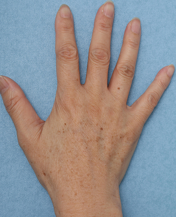フォトフェイシャルM22,手の甲のシミ治療の症例写真,Before,ba_ipl011_b02.jpg