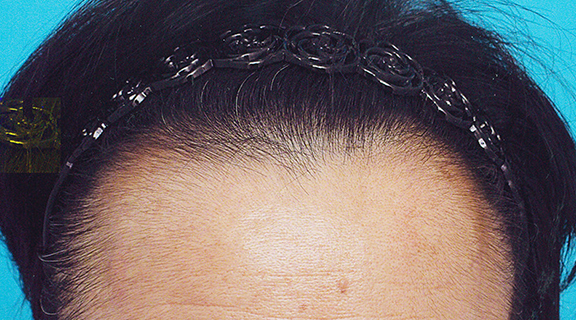 AGA治療（高須式メディカル育毛プログラム）,育毛治療男性の症例写真,After（2ヶ月後）,ba_aga_028_b01.jpg