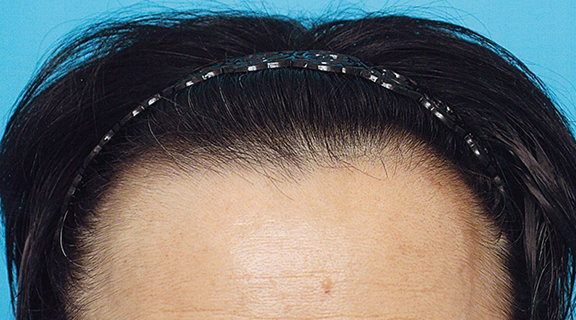AGA治療（高須式メディカル育毛プログラム）,育毛治療男性の症例写真,Before,ba_aga_028_b01.jpg