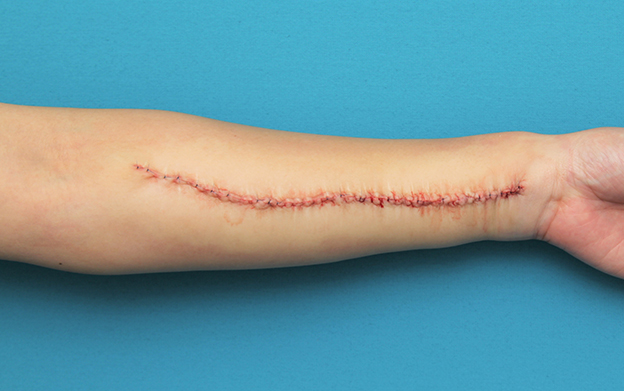 傷跡,リストカットの傷跡を2回に分けて切除縫合手術した症例写真,1回目手術直後,mainpic_keisei018b.jpg