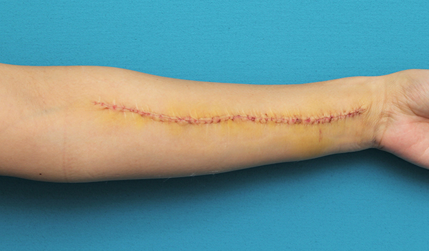 傷跡,リストカットの傷跡を2回に分けて切除縫合手術した症例写真,1回目手術後1週間,mainpic_keisei018c.jpg