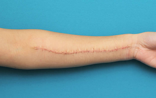傷跡,リストカットの傷跡を2回に分けて切除縫合手術した症例写真,1回目手術後1ヶ月,mainpic_keisei018d.jpg