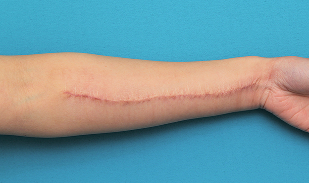 傷跡,リストカットの傷跡を2回に分けて切除縫合手術した症例写真,1回目手術後3ヶ月,mainpic_keisei018e.jpg