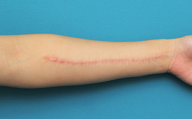 傷跡,リストカットの傷跡を2回に分けて切除縫合手術した症例写真,1回目手術後6ヶ月,mainpic_keisei018f.jpg
