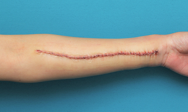 傷跡,リストカットの傷跡を2回に分けて切除縫合手術した症例写真,2回目手術直後,mainpic_keisei018g.jpg