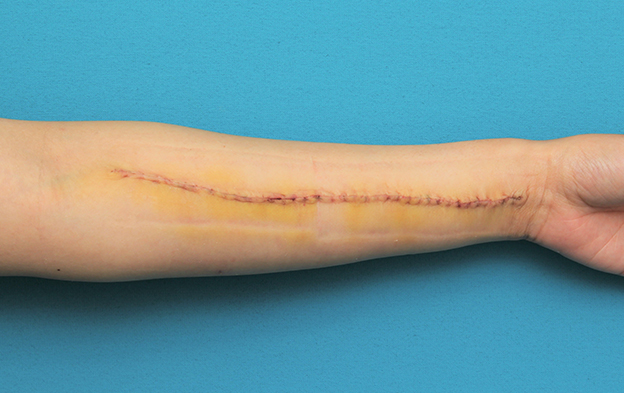 傷跡,リストカットの傷跡を2回に分けて切除縫合手術した症例写真,2回目手術後1週間,mainpic_keisei018h.jpg