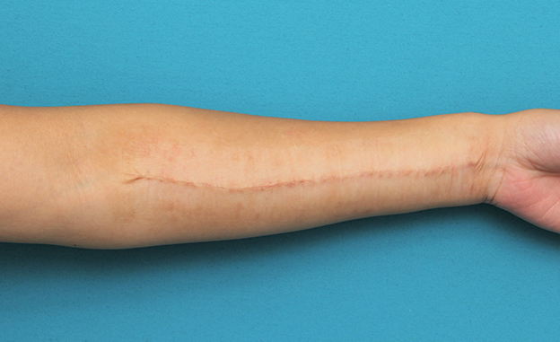 リストカット・根性焼き,リストカットの傷跡を2回に分けて切除縫合手術した症例写真,2回目手術後3ヶ月,mainpic_keisei018j.jpg