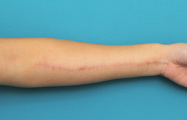 傷跡,リストカットの傷跡を2回に分けて切除縫合手術した症例写真,2回目手術後6ヶ月,mainpic_keisei018k.jpg