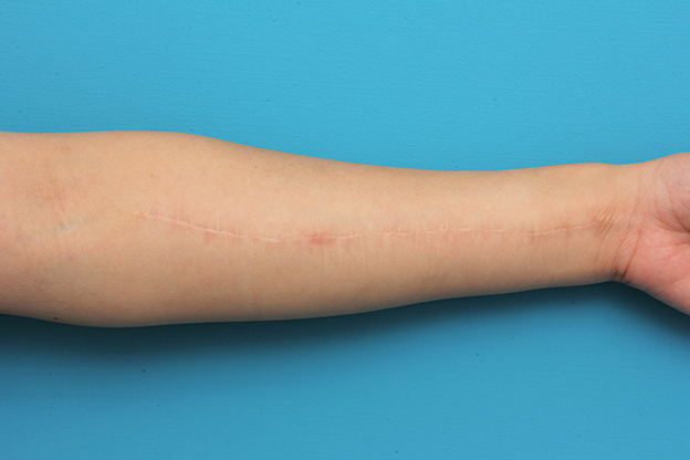 リストカット・根性焼き,リストカットの傷跡を2回に分けて切除縫合手術した症例写真,2回目手術後1年,mainpic_keisei018l.jpg
