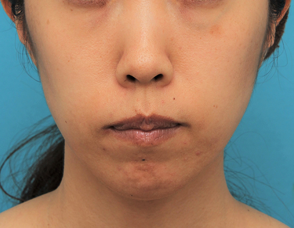 ガミースマイル手術,ガミースマイルを手術で治した40代女性の症例写真,Before,ba_gammy006_b02.jpg