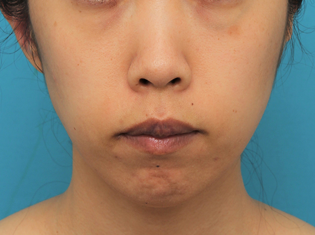 症例写真,ガミースマイルを手術で治した40代女性の症例写真,6日後,口を閉じた状態,mainpic_gammy006e.jpg