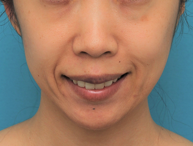 症例写真,ガミースマイルを手術で治した40代女性の症例写真,6日後,口を開けた状態,mainpic_gammy006f.jpg
