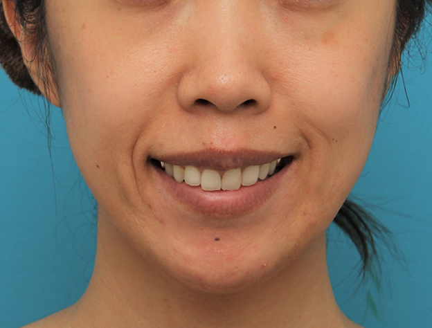 症例写真,ガミースマイルを手術で治した40代女性の症例写真,3週間後,口を開けた状態,mainpic_gammy006h.jpg