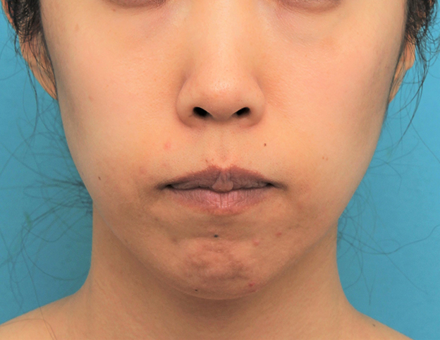 ガミースマイル手術,ガミースマイルを手術で治した40代女性の症例写真,6ヶ月後,口を閉じた状態,mainpic_gammy006k.jpg