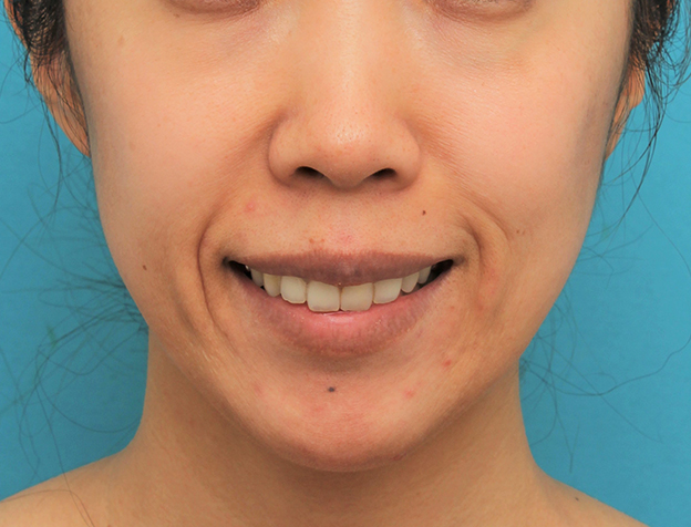 ガミースマイル手術,ガミースマイルを手術で治した40代女性の症例写真,6ヶ月後,口を開けた状態,mainpic_gammy006l.jpg