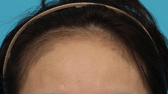 AGA治療（高須式メディカル育毛プログラム）,女性の薄毛治療（内服薬（ミノキシジル）、PRP育毛治療（第三種再生医療））の症例写真,After（1ヶ月後）,ba_aga_josei004_b01.jpg