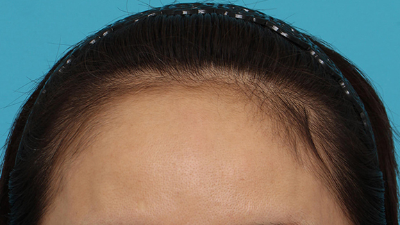 女性の薄毛治療（内服薬（ミノキシジル）、PRP育毛治療（第三種再生医療））の症例写真,Before,ba_aga_josei004_b01.jpg