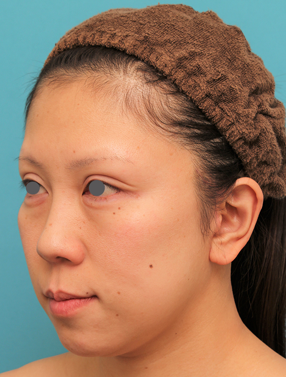 ミディアムフェイスリフト,ミディアムフェイスリフトの症例 顔の下半分のたるみが目立つ40代女性,After（2ヶ月後）,ba_mediumlift013_b02.jpg