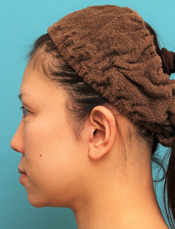症例写真,ミディアムフェイスリフトの症例 顔の下半分のたるみが目立つ40代女性,After（2ヶ月後）,ba_mediumlift013_b03.jpg