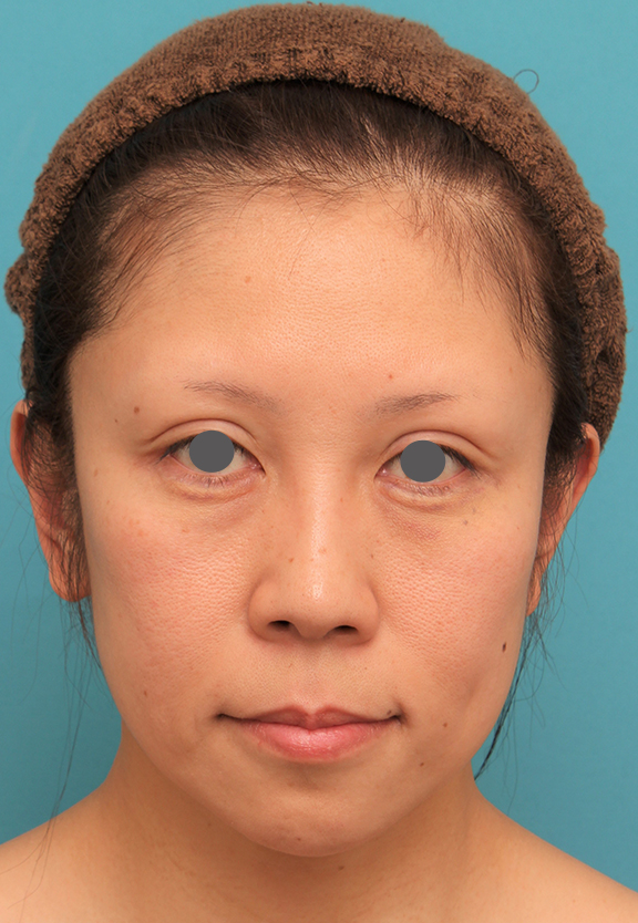 ミディアムフェイスリフト,ミディアムフェイスリフトの症例 顔の下半分のたるみが目立つ40代女性,Before,ba_mediumlift013_b01.jpg