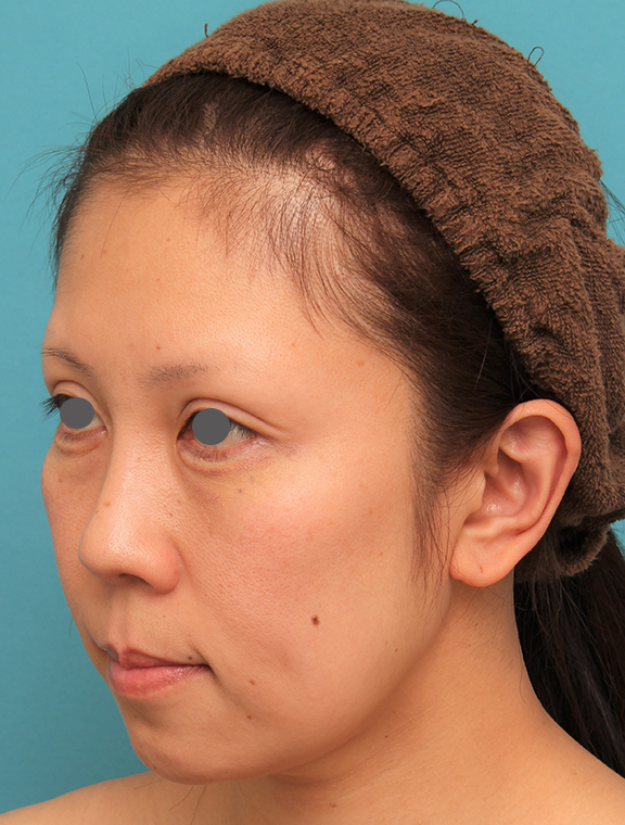 ミディアムフェイスリフト,ミディアムフェイスリフトの症例 顔の下半分のたるみが目立つ40代女性,Before,ba_mediumlift013_b02.jpg
