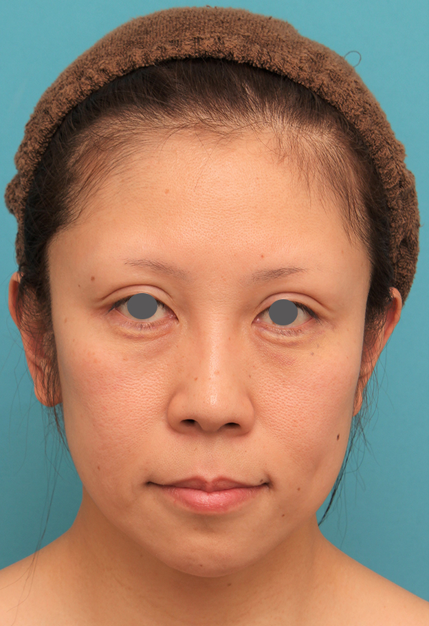症例写真,ミディアムフェイスリフトの症例 顔の下半分のたるみが目立つ40代女性,手術前,mainpic_mediumlift013a.jpg