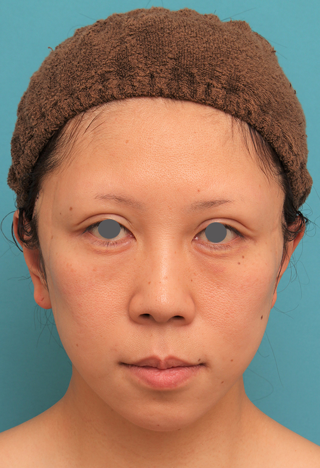 ミディアムフェイスリフト,ミディアムフェイスリフトの症例 顔の下半分のたるみが目立つ40代女性,手術直後,mainpic_mediumlift013b.jpg