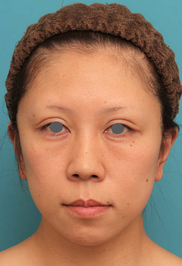 症例写真,ミディアムフェイスリフトの症例 顔の下半分のたるみが目立つ40代女性,6日後,mainpic_mediumlift013c.jpg