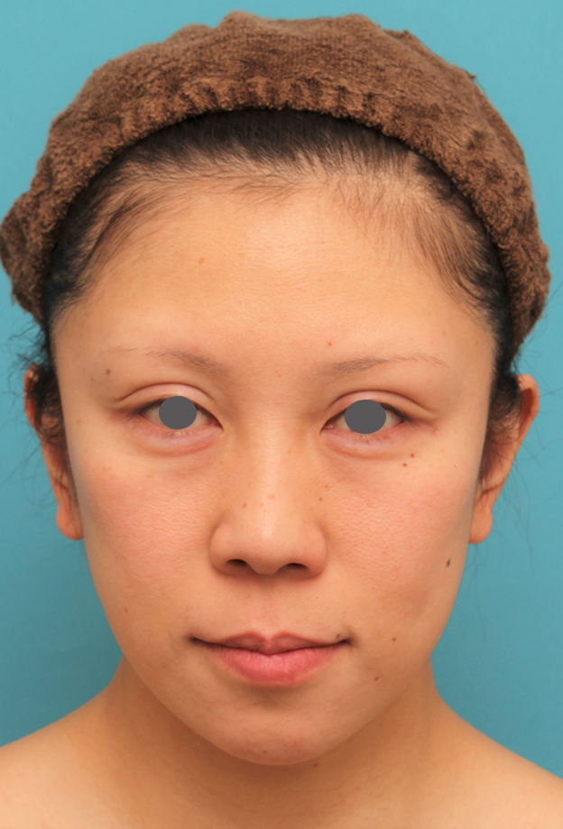 症例写真,ミディアムフェイスリフトの症例 顔の下半分のたるみが目立つ40代女性,2ヶ月後,mainpic_mediumlift013d.jpg