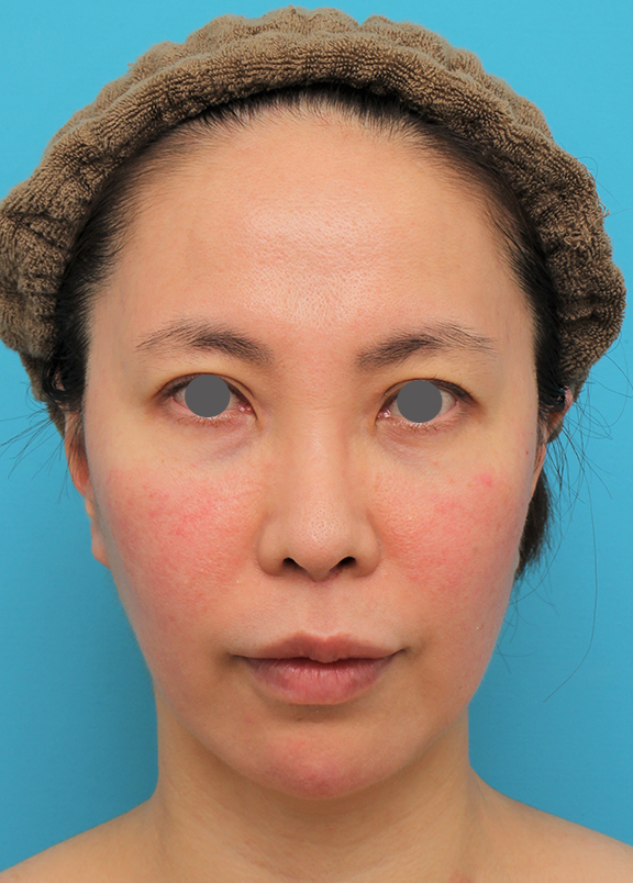 ミディアムフェイスリフト,ミディアムフェイスリフト＋人中短縮＋鼻柱への耳介軟骨移植を行った症例写真,After（6ヶ月後）,ba_mediumlift014_b01.jpg