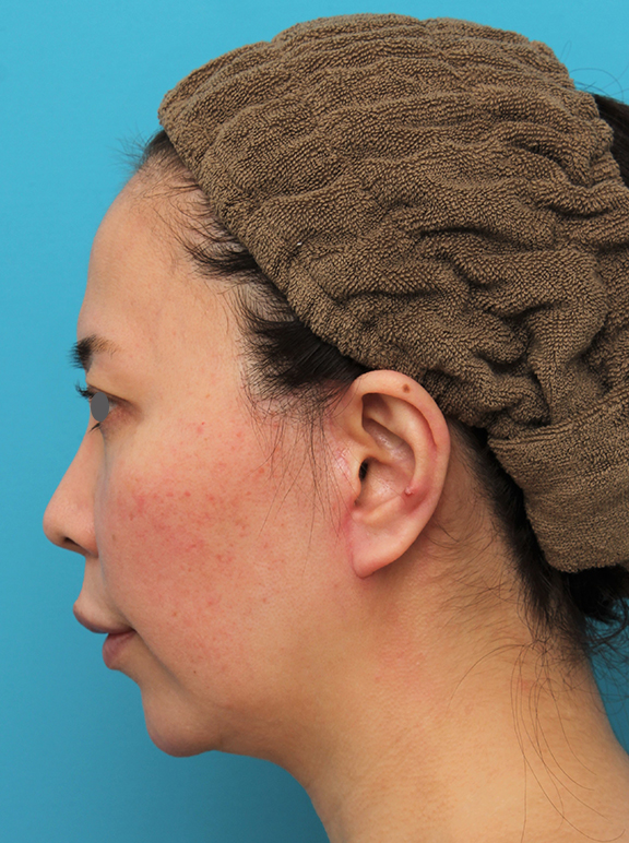 ミディアムフェイスリフト,ミディアムフェイスリフト＋人中短縮＋鼻柱への耳介軟骨移植を行った症例写真,After（6ヶ月後）,ba_mediumlift014_b03.jpg