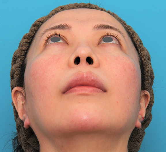 鼻の下を短く（上口唇短縮手術、上口唇リフト、リップリフト、人中短縮術）,ミディアムフェイスリフト＋人中短縮＋鼻柱への耳介軟骨移植を行った症例写真,After（6ヶ月後）,ba_mediumlift014_b04.jpg