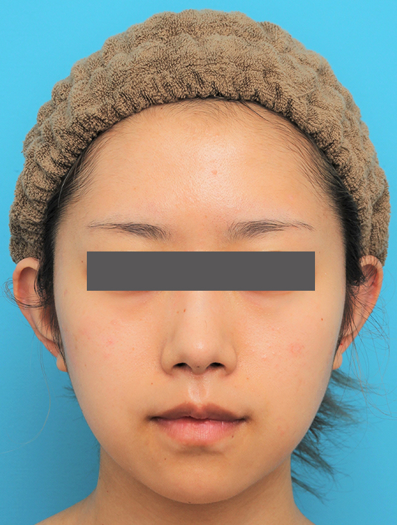 鼻の下を短く（上口唇短縮手術、上口唇リフト、リップリフト、人中短縮術）,人中短縮手術（リップリフト）を行った20代女性の症例写真,After（6ヶ月後）,ba_hanashita005_b01.jpg