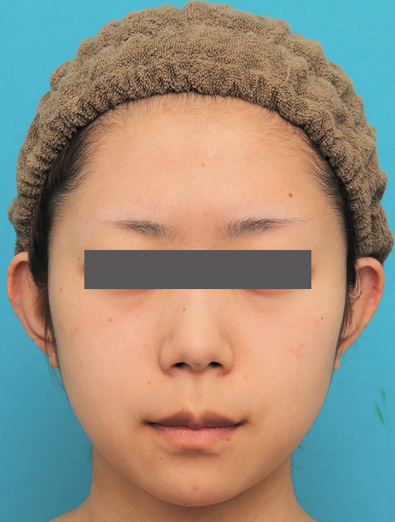 鼻の下を短く（上口唇短縮手術、上口唇リフト、リップリフト、人中短縮術）,人中短縮手術（リップリフト）を行った20代女性の症例写真,Before,ba_hanashita005_b01.jpg